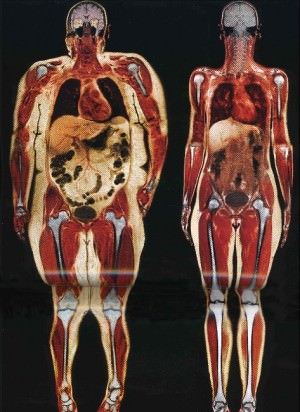 White areas are fatty tissue. The person on the left has fat surrounding internal organs.